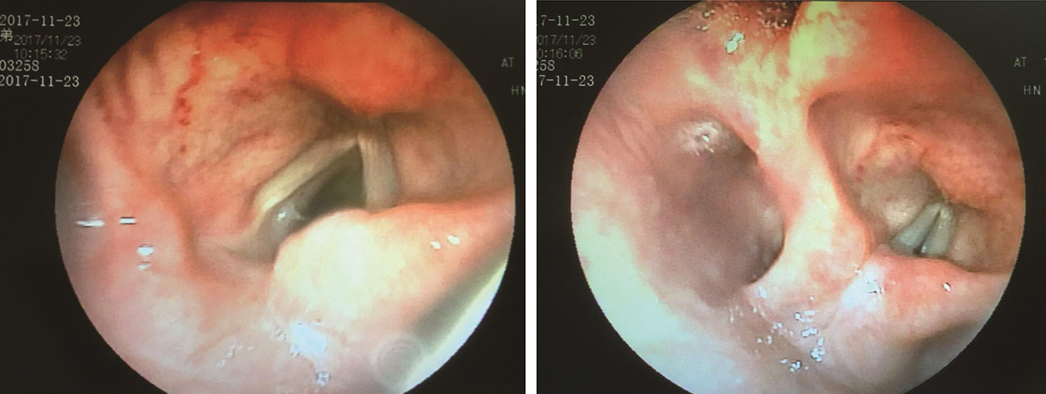 /uploads/image/2025-05-26/163931876图14 2017年11月23日复查喉镜.jpg 图14 2017年11月23日复查喉镜
